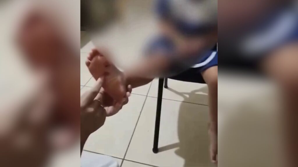 Padrasto é suspeito de queimar pé de enteada de 4 anos com isqueiro